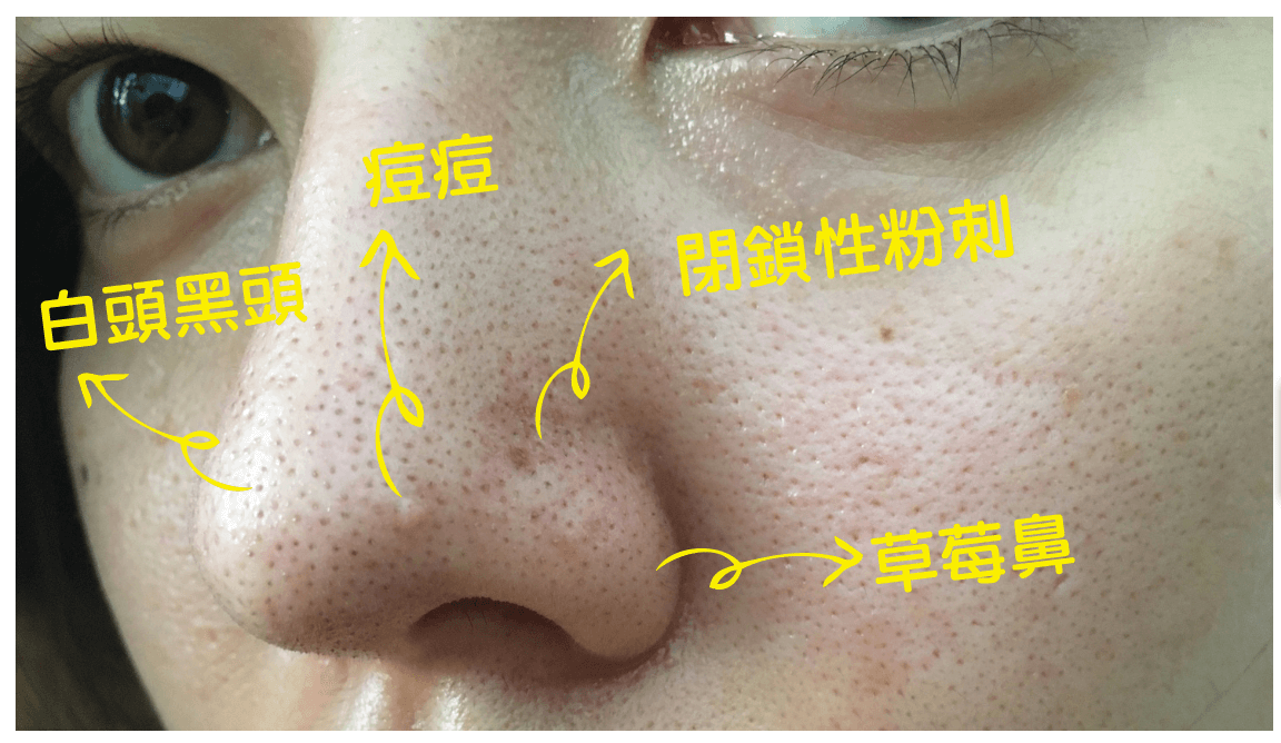 俏樂斯 曾沛慈 粉刺 美白 卸妝 幼美肌 黑頭 淡化斑點 保濕 草莓鼻 閉鎖性粉刺 坑洞 海洋透潤 褐藻 碳酸泡泡 碳酸洗顏 碳酸 洗面乳 潔顏 