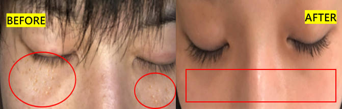 俏樂斯 曾沛慈 小綠餅 美白 抗皺 幼美肌 全方位保濕水凝霜 肉芽 顆粒 脂肪粒 醫美 電燒 除肉芽 淡化斑點 保濕 凝膠 沖繩 薏米 巴鈺