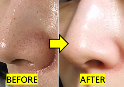 俏樂斯 曾沛慈 小綠餅 美白 抗皺 幼美肌 全方位保濕水凝霜 肉芽 顆粒 脂肪粒 醫美 電燒 除肉芽 淡化斑點 保濕 凝膠 沖繩 薏米 巴鈺 抗痘 痘痘 痘疤